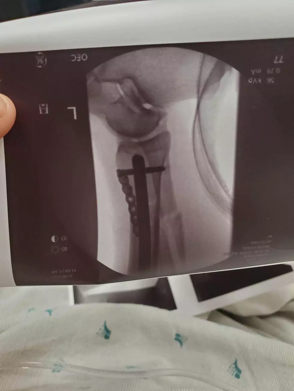 Terry Poma xray